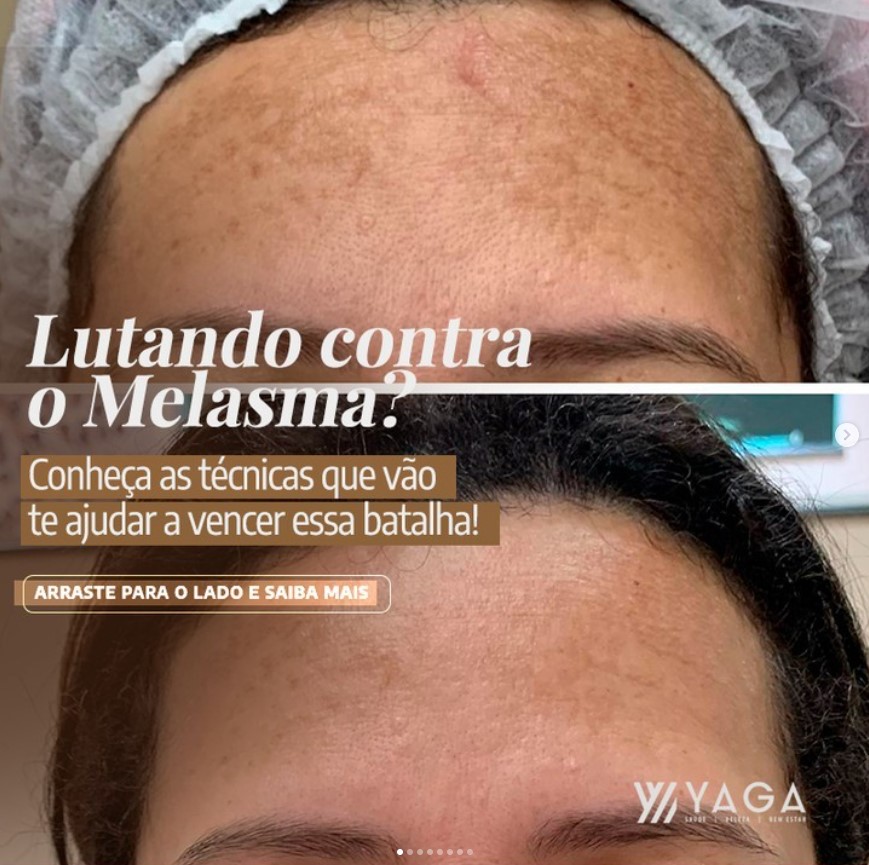 Lutando contra o Melasma? Connheça as técnicas que vão te ajudar a vencer essa batalha!